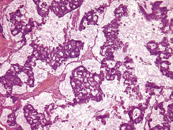 FIG. 17.14, Metastatic appendiceal adenocarcinoma. The signet-ring cells, which are free-floating in mucin, grow in thick irregular trabeculae with striking cribriform growth.