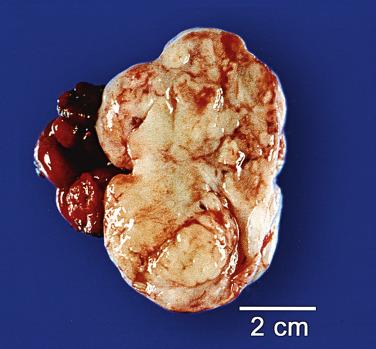 FIG. 17.16, Metastatic gastric adenocarcinoma. The cut surface is heterogeneous with multiple tan nodules that are juxtaposed to glistening areas. Notice areas of hemorrhage and necrosis as well as surface involvement.