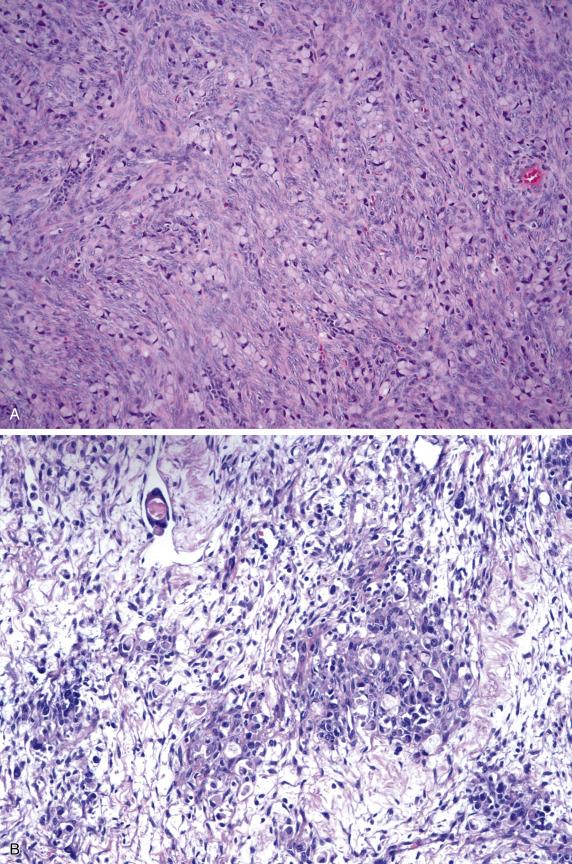 FIG. 17.17, Metastatic gastric poorly cohesive (signet-ring cell) carcinoma (Krukenberg tumor). At low power, the tumor closely resembles a fibroma; notice the presence of multiple scattered signet-ring cells (A). Irregular nests of signet-ring cells are embedded in a prominent hypocellular edematous background containing few tumor cells; lymphovascular invasion is present (upper left corner) (B). Transition from hyper- to hypocellular areas is often abrupt (C).