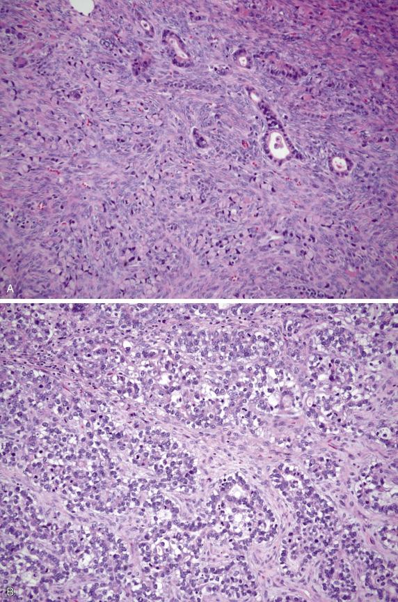 FIG. 17.18, Metastatic gastric poorly cohesive (signet-ring) cell carcinoma (Krukenberg tumor). Relatively well-formed but atypical glands are seen in association with an extensive signet-ring cell component (A). These tumors may also show neoplastic cells growing in inter-anastomosing trabeculae (B).