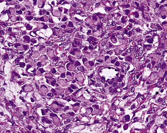 FIG. 17.19, Metastatic gastric poorly cohesive (signet-ring) cell carcinoma (Krukenberg tumor). The tumor cells grow in sheets and they contain intracytoplasmic mucin and eccentrically located, crescent-shaped nuclei.