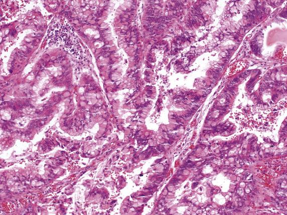 FIG. 17.20, Metastatic tubular (intestinal-type) gastric carcinoma. Medium to large back-to-back glands with focal intraluminal papillary growth.