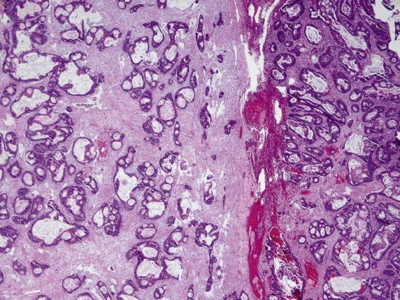 FIG. 17.2, Metastatic colorectal adenocarcinoma. Neoplastic glands are variably sized, ranging from simple to cystically dilated or cribriform. Notice the multinodular growth.