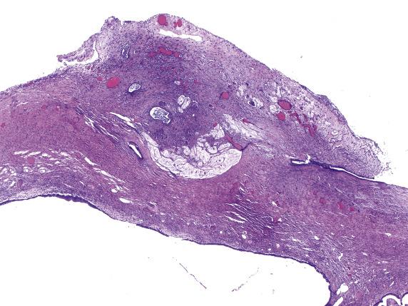 FIG. 17.21, Metastatic cholangiocarcinoma. A nodular plaque of tumor involves the ovarian surface.