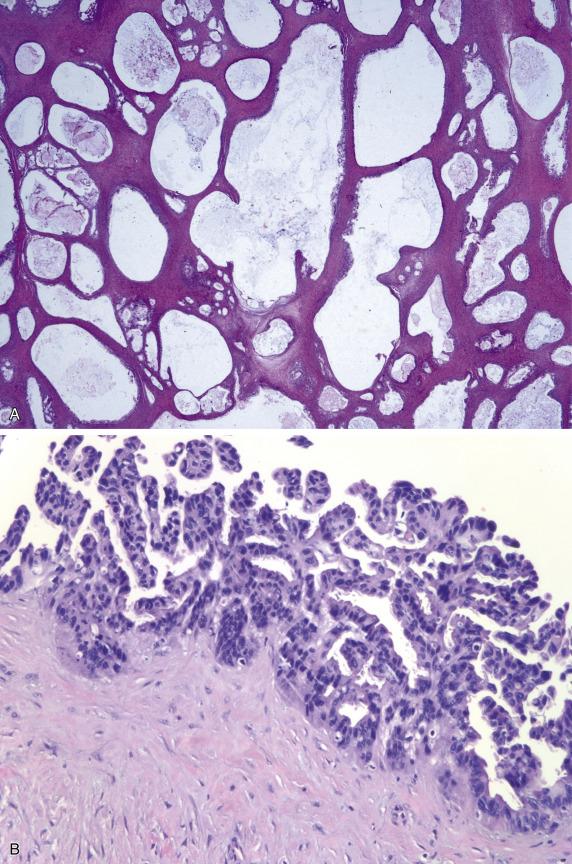 FIG. 17.22, Metastatic pancreatic adenocarcinoma. Simple and cystically dilated glands are present in a fibromatous background, mimicking a primary ovarian mucinous cystadenoma (A). The tumor has papillary growth simulating a borderline tumor (B). Irregularly shaped and sized glands infiltrate a desmoplastic stroma (C).