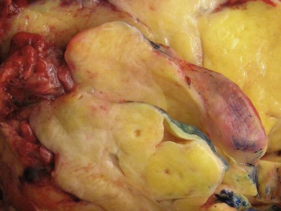 FIG. 17.25, Metastatic breast carcinoma. The tumor has a striking tan to yellow, nodular, and homogeneous cut surface resembling the gross appearance of a sex cord-stromal tumor.