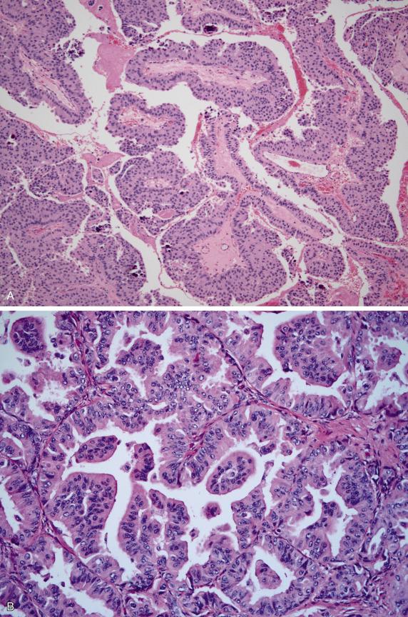 FIG. 17.27, Metastatic breast carcinoma, ductal type. Large, irregular, and variably sized papillae associated with calcification may mimic a papillary serous neoplasm (A). Tumors may also show variably sized glands with intraluminal papillae (B).