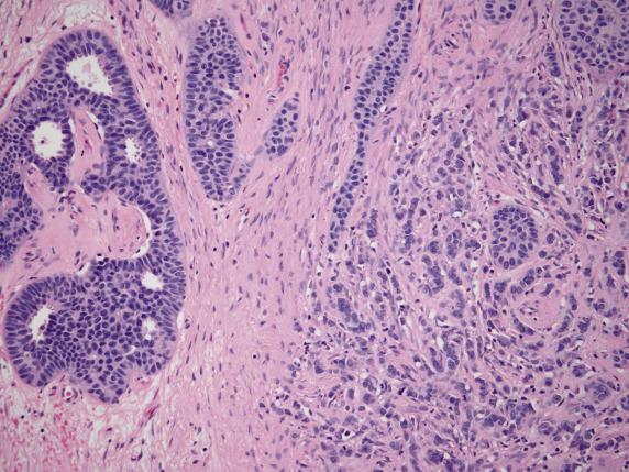 FIG. 17.28, Metastatic breast carcinoma, mixed ductal and lobular type. Cribriform architecture characteristic of ductal carcinoma is juxtaposed to single cells forming cords typical of lobular carcinoma.
