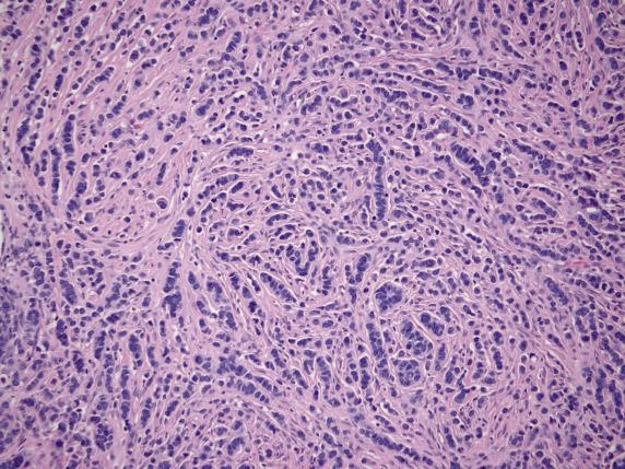 FIG. 17.29, Metastatic breast carcinoma, lobular type. Single cells, parallel cords, and occasional clusters of tumor cells are embedded in a collagenous stroma.