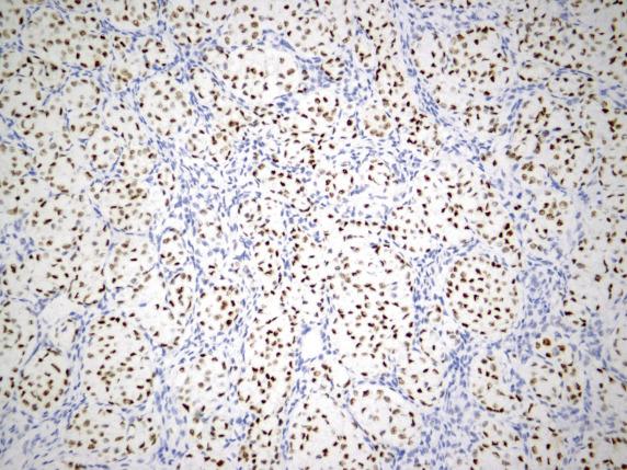 FIG. 17.30, Metastatic breast carcinoma. The tumor cells are strongly and diffusely positive for GATA3.