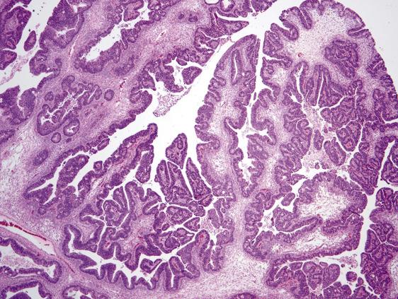 FIG. 17.3, Metastatic large intestinal adenocarcinoma. The papillary architecture can be mistaken for a borderline tumor (courtesy of Russell Vang and Brigitte M. Ronnett, Johns Hopkins University).