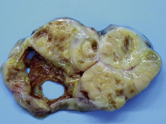 FIG. 17.31, Metastatic pulmonary adenocarcinoma. The tumor has a yellow-tan lobulated cut surface with focal cyst formation.