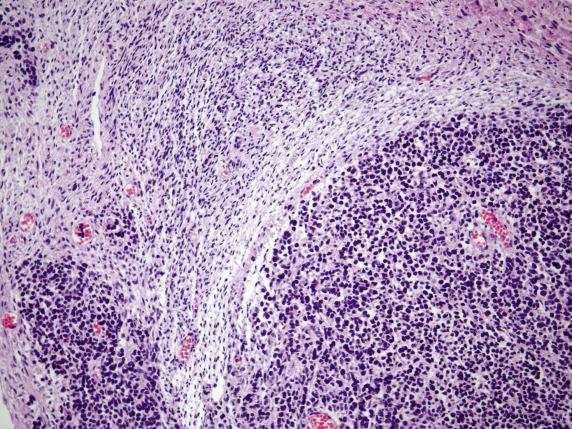 FIG. 17.32, Metastatic pulmonary small cell neuroendocrine carcinoma. The small hyperchromatic tumor cells grow in sheets.