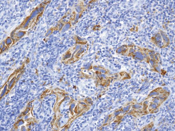 FIG. 17.34, Metastatic pulmonary adenocarcinoma. The tumor cells are Napsin-A positive.