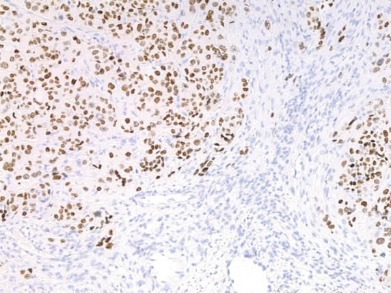 FIG. 17.35, Metastatic pulmonary large cell neuroendocrine carcinoma. The tumor cells show diffuse nuclear TTF1 positivity.