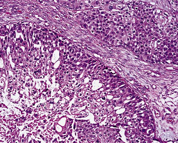 FIG. 17.36, Metastatic urothelial carcinoma of the urinary bladder. Low-grade transitional cell epithelium exhibits partial squamous differentiation.