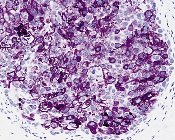 FIG. 17.37, Metastatic urothelial carcinoma of the urinary bladder. The tumor exhibits strong cytoplasmic and membranous CK20 expression.