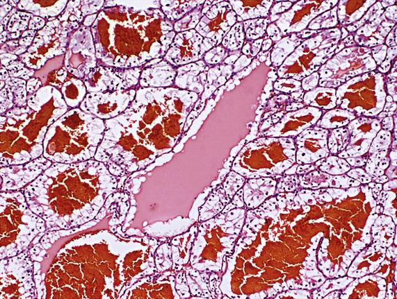 FIG. 17.38, Metastatic renal clear cell carcinoma. Dilated tubules containing blood and colloid-like secretions are lined by cells with abundant clear cytoplasm.