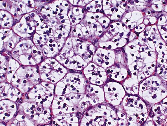 FIG. 17.39, Metastatic renal clear cell carcinoma. The cells contain abundant clear cytoplasm and round low-grade nuclei.