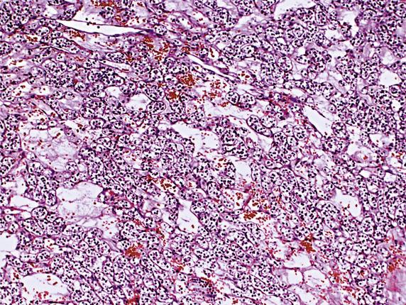 FIG. 17.40, Metastatic renal clear cell carcinoma. Note the prominent sinusoidal vasculature.