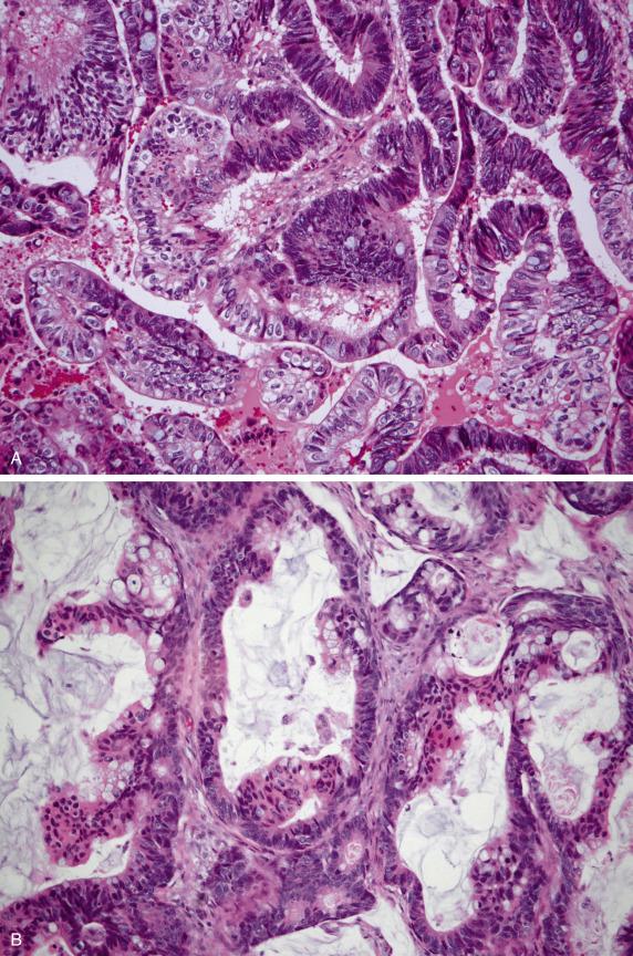 FIG. 17.4, Metastatic large intestinal adenocarcinoma. As the degree of mucinous differentiation varies between tumors and within tumors, they may have a mucin-poor endometrioid-like appearance including the finding of clear cells (A), a “hybrid” morphology (B), and a mucin-rich (colloid-like) appearance (C).