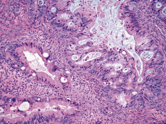 FIG. 17.5, Metastatic large intestinal adenocarcinoma. The tumor often has low-grade architecture and high-grade cytology.