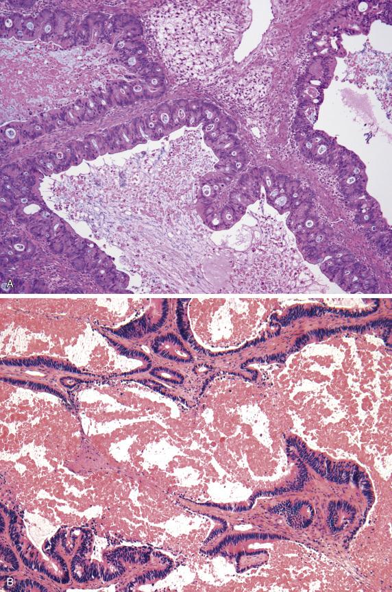 FIG. 17.6, Metastatic large intestinal adenocarcinoma. The neoplastic epithelium in the cystically dilated glands is cribriform, imparting a “garland” appearance (A). Necrotic material containing cellular debris (“dirty necrosis”) as well as segmental necrosis can be seen (B).