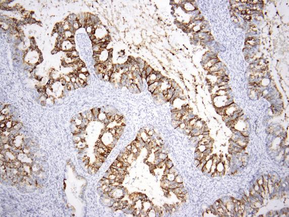 FIG. 17.7, Metastatic large intestinal adenocarcinoma. Extensive CK7 positivity can be seen in these tumors especially when they originate from the right side of the colon or rectum.