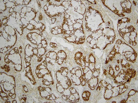 FIG. 17.8, Metastatic large intestinal adenocarcinoma. The tumor cell nuclei are diffusely positive for SATB2.