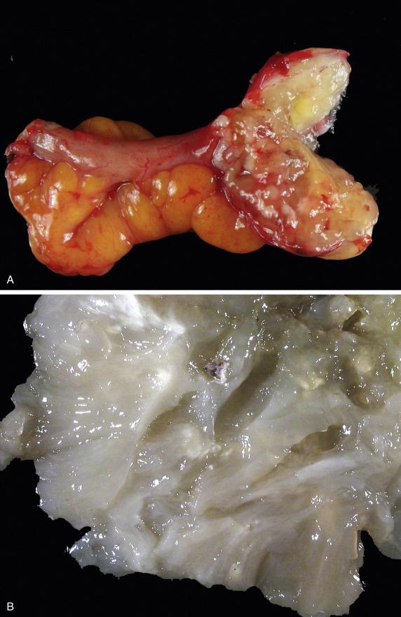 FIG. 17.9, Low-grade mucinous appendiceal neoplasm with secondary ovarian involvement. The appendix is enlarged, and sectioning reveals a lumen filled and distended by gelatinous material (A). The ovary is mostly replaced by gelatinous contents which obscures the cyst walls (B).