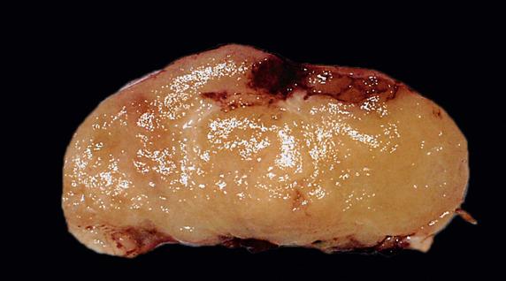 FIG. 17.10, Metastatic appendiceal adenocarcinoma. The tumor has a tan-yellow, solid, and mucoid cut surface.