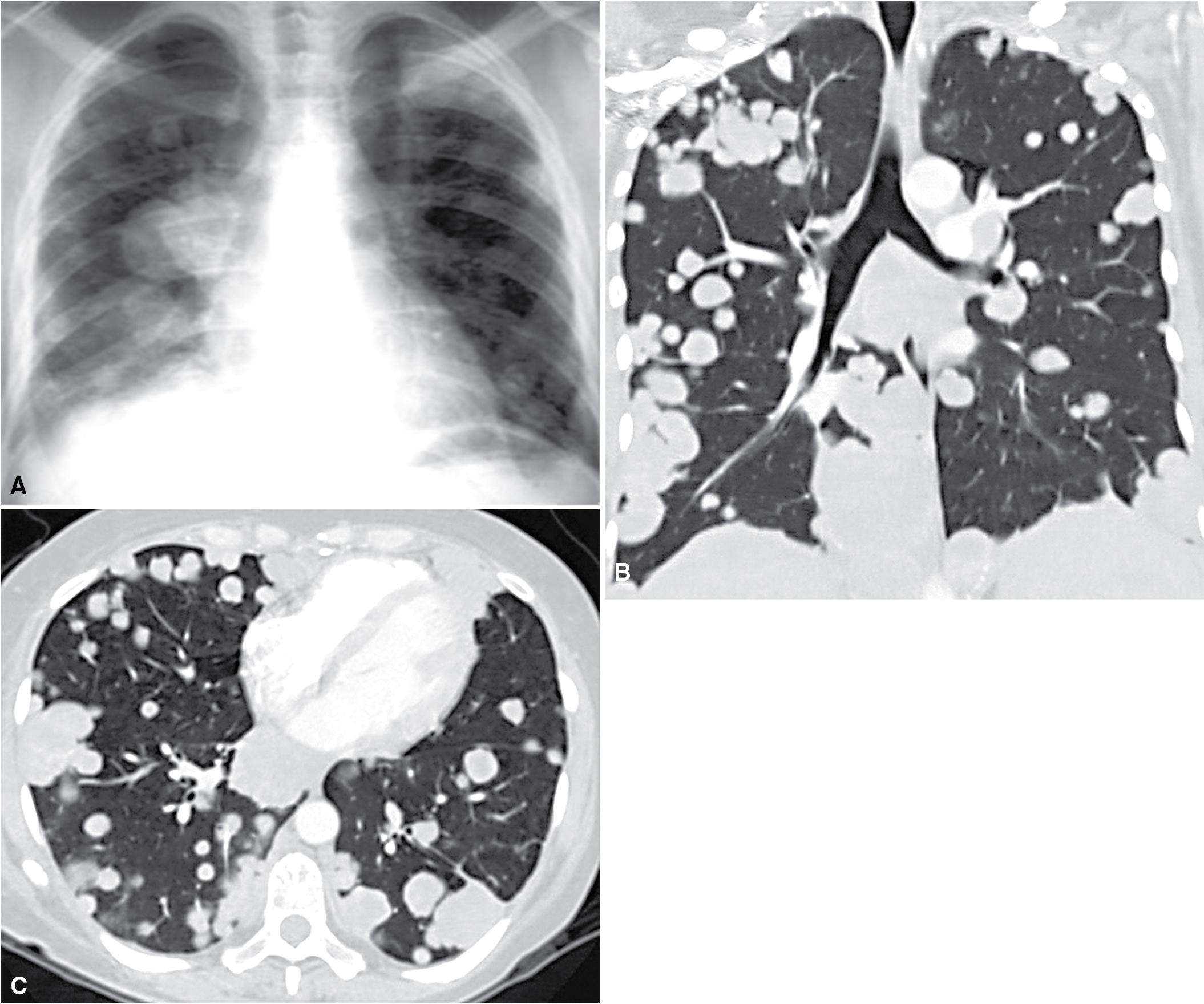 Figure 18.1, (A) Chest radiograph in a case of metastatic colorectal carcinoma involving the lungs. Tumor nodules are distributed throughout both lung fields; they are nodular and of variable sizes. The lesions are well seen in a reconstructed sagittal computed tomogram (B) and a conventional cross-sectional computed tomogram (C).