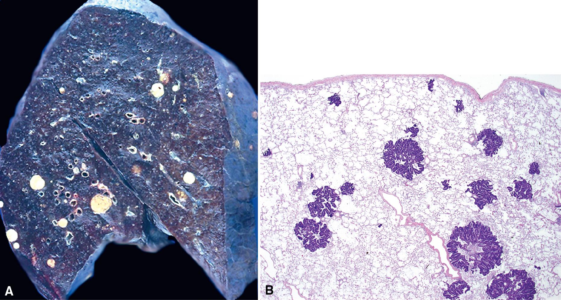 Figure 18.3, (A) Gross photograph from another case of metastatic carcinoma involving the lungs (from a primary tumor in the breast). The multifocal nature and heterogeneous size of metastatic lesions are well shown. (B) The variably sized metastatic tumor nodules are found diffusely within lung parenchyma.