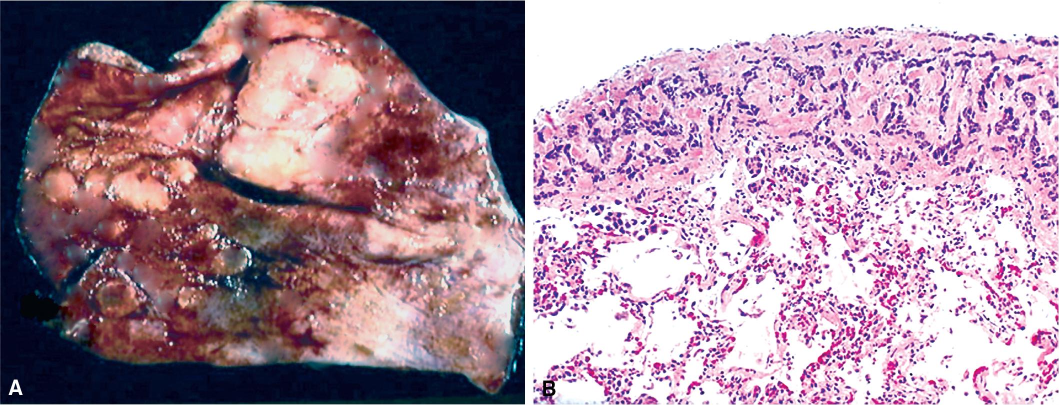 Figure 18.4, (A) Gross image of pleura showing multiple variably sized subpleural metastases. (B) Photomicrograph from a case of metastatic adenocarcinoma in the lung showing a subpleural peripheral distribution of tumor within the pulmonary parenchyma.