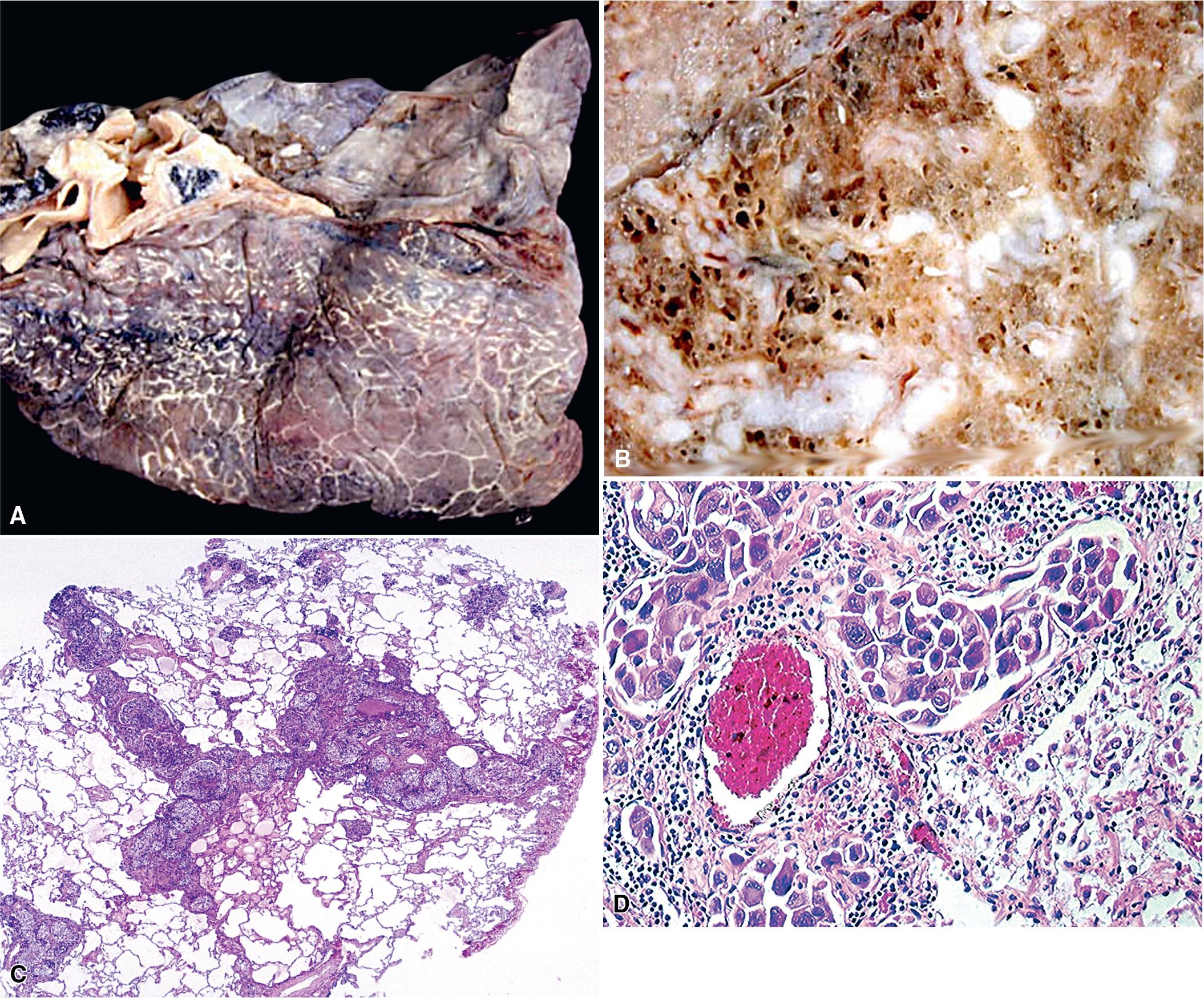 Figure 18.7, A linear pattern of lymphangitic metastatic disease in the lung parenchyma is seen in gross photographs (A and B) and a low-magnification photomicrograph (C). (D) At higher magnification, metastatic carcinoma fills and expands the lymphatic channels in the lungs.