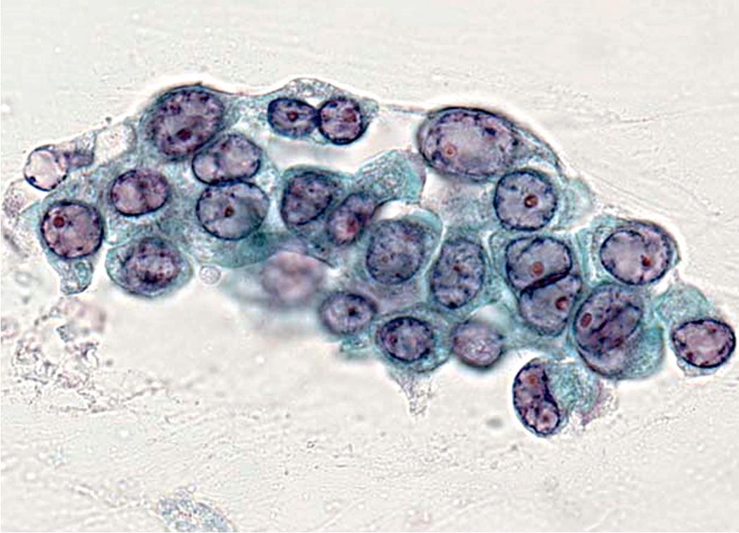 Figure 18.9, Metastatic adenocarcinoma of pulmonary origin is seen in this preparation of a cytologic specimen of pleural fluid. The tumor cells are arranged in a vaguely three-dimensional configuration, and small nucleoli are seen.