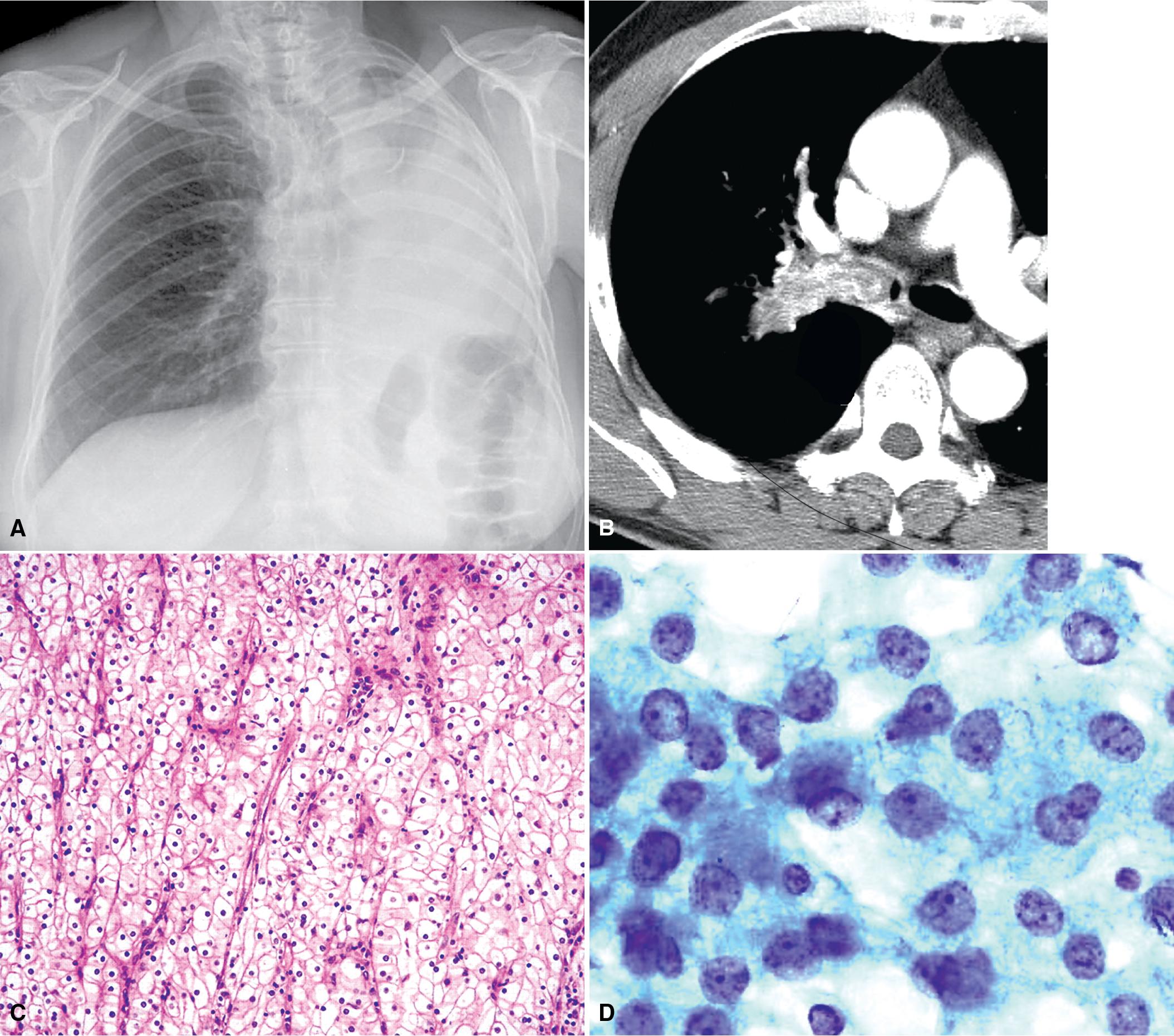 Figure 18.10, (A) Chest radiograph showing left upper lobar atelectasis in a case of intrabronchial metastasis of renal cell carcinoma. (B) Computed tomography scan showing another case of metastatic intrabronchial carcinoma (from the breast), affecting the right mainstem bronchus. (C) Bland polygonal tumor cells with characteristic clear cytoplasm are seen in the biopsy specimen. (D) The associated bronchial brushing shows renal cell carcinoma cells with relatively uniform nuclei and clear cytoplasm. (E) Intrabronchial metastasis of melanoma, represented by a pigmented polyploid mass. (F) The tumor contains abundant melanin.