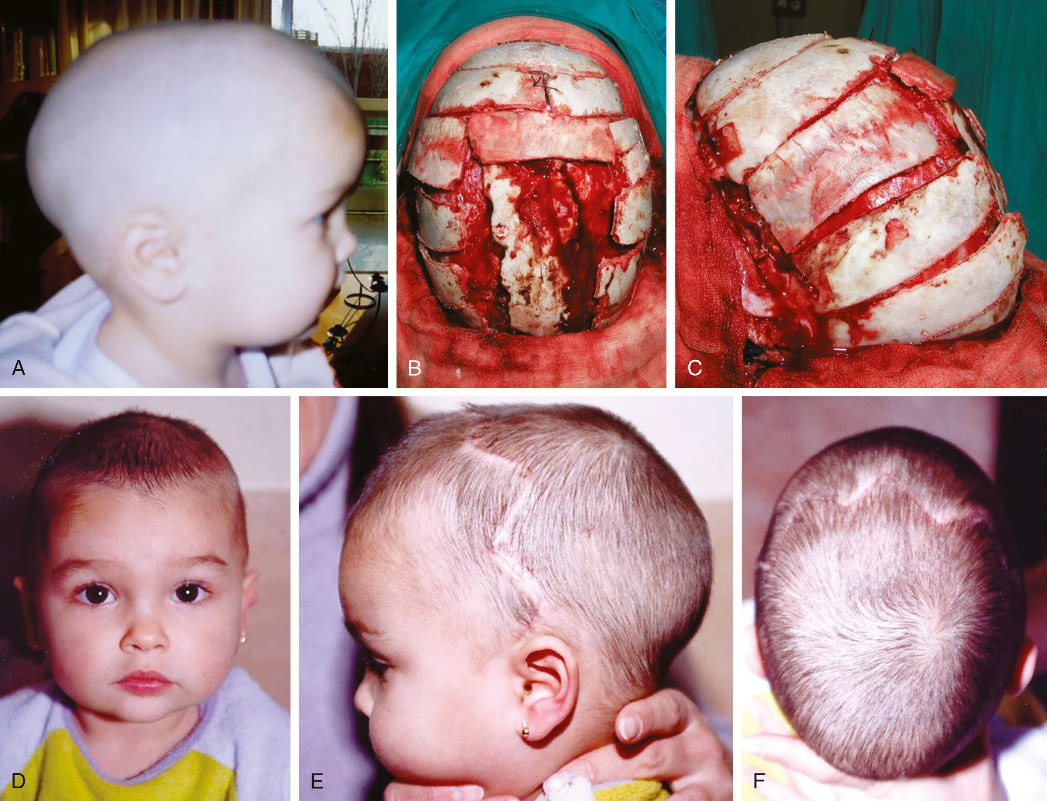 FIGURE 79.4, Holocranial dismantling in an older scaphocephaly patient. (A) The preoperative side view demonstrates scaphocephaly. Intraoperative bird’s eye (B) and side (C) views demonstrate osteotomies and synostectomy. Postoperative frontal (D), side (E), and bird’s eye (F) views show correction of scaphocephaly.