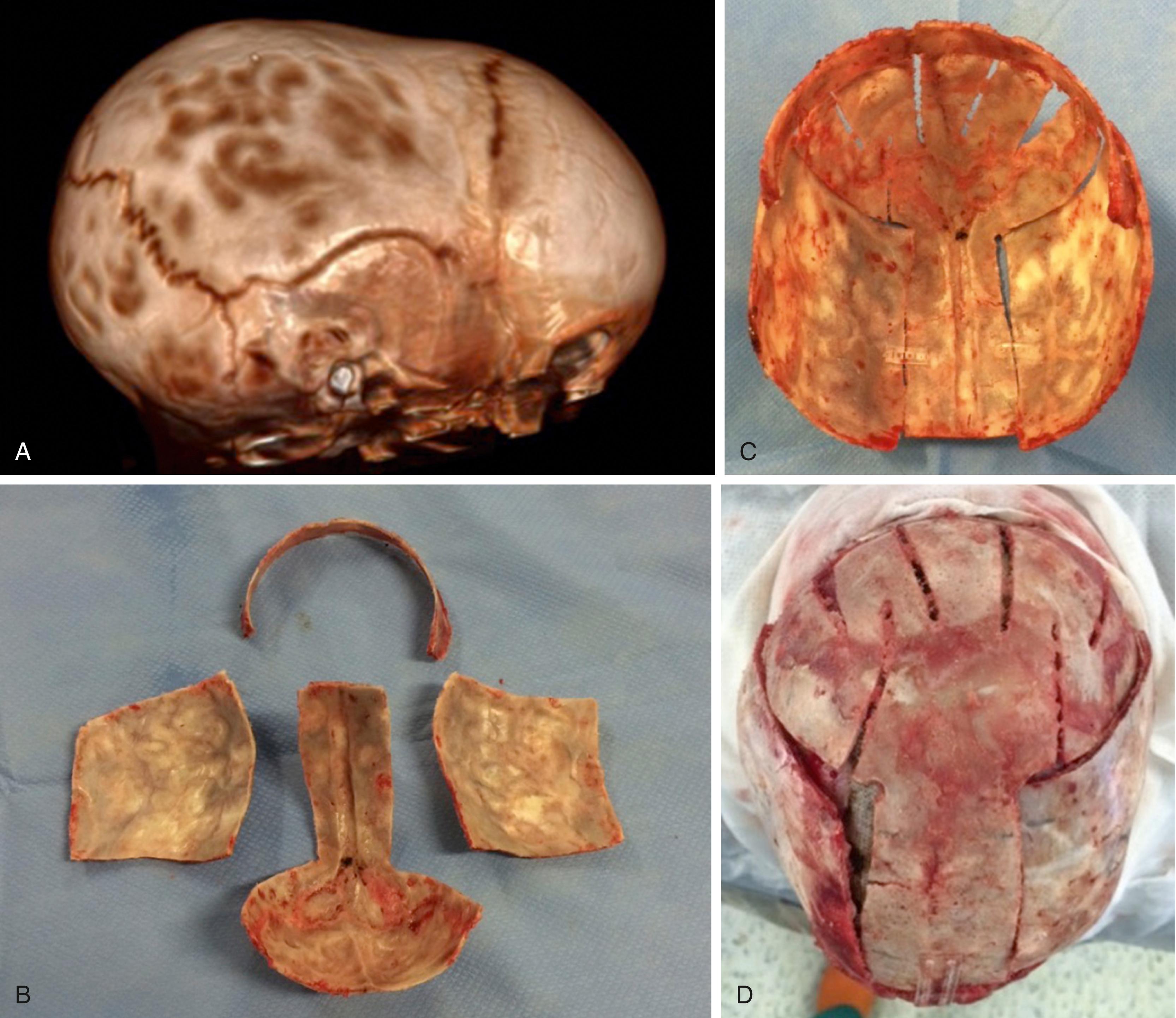 FIGURE 79.5, In older children, around the age of 12 to 18 months, a whole cranial dismantling with the Melbourne technique may be indicated. (A) preoperative computed tomography; (B) osteotomies; (C) reorganization of fragments with increased biparietal width; and (D) final aspect.