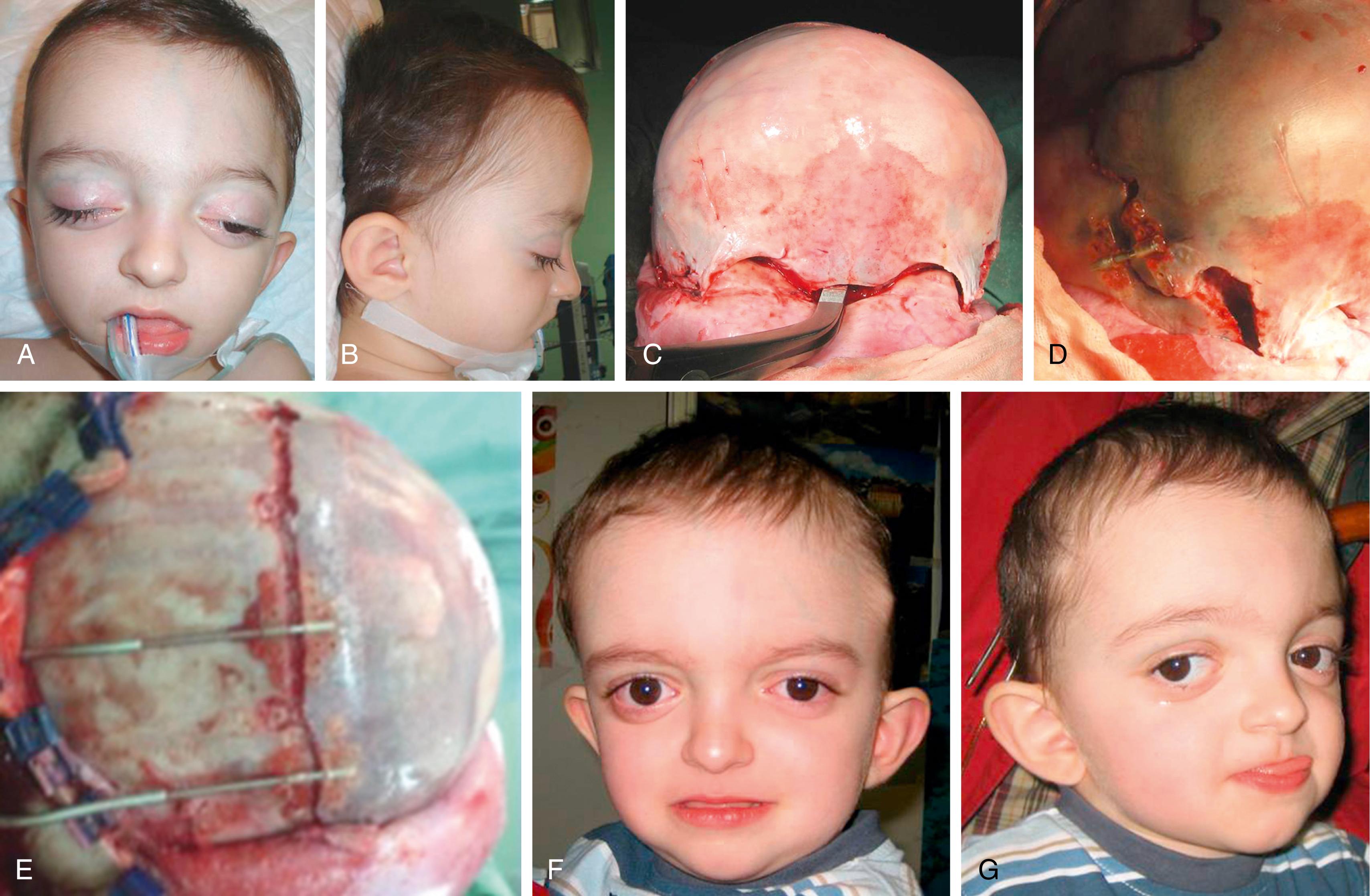 FIGURE 79.10, Fronto-orbital distraction with resorbable devices for anterior advancement. Predistraction frontal (A) and side (B) views show a harmonic Crouzon syndrome patient. In intraoperative frontal (C) and side (D) view images, observe pterional resection and osteotomy lines. (E) Intraoperative high magnification of distraction devices. Postoperative frontal (F) and oblique (G) views are shown during distraction. Observe improvement in proptosis. Polysomnography also improved at the end of distraction in this patient with preoperative raised intracranial pressure and central apnea.