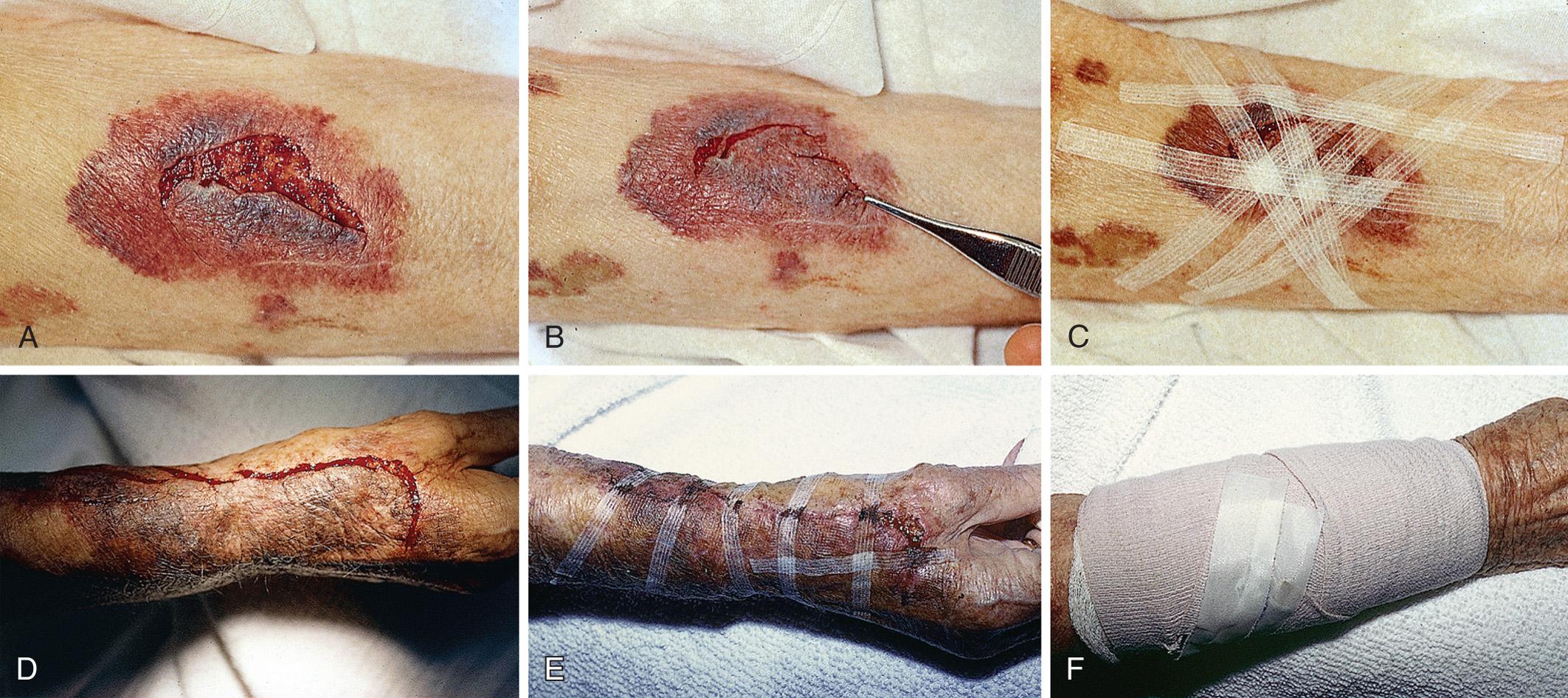 Figure 35.2, Wound tape in the care of avulsion injuries is preferred over sutures (see Fig. 35.5 ). A skin avulsion in the elderly following minor trauma is an ideal wound to repair with closure tape because such injuries cannot be closed with sutures. The goal is to provide approximation of the avulsed skin and apply pressure to avoid movement of the skin flap or accumulation of fluid under the avulsion. Tissue glue can augment this procedure. A, An elderly woman who was taking steroids had extremely thin skin and suffered a skin avulsion that could not be repaired with sutures. B, The skin edges are uncurled, stretched, and anatomically replaced. C, The wound should heal while closure tape keeps the skin in place. Tissue glue (Dermabond, Ethicon Inc.) was also dabbed on various parts of the edges to allow egress of fluid. D, Another elderly patient with a large avulsion injury on the forearm. E, Repair with Steri-Strips (3M) and skin glue. F, A compression dressing, such as an elastic bandage or a Dome paste (Unna boot) dressing, can be applied to minimize movement of the flap and decrease buildup of fluid under the flap.