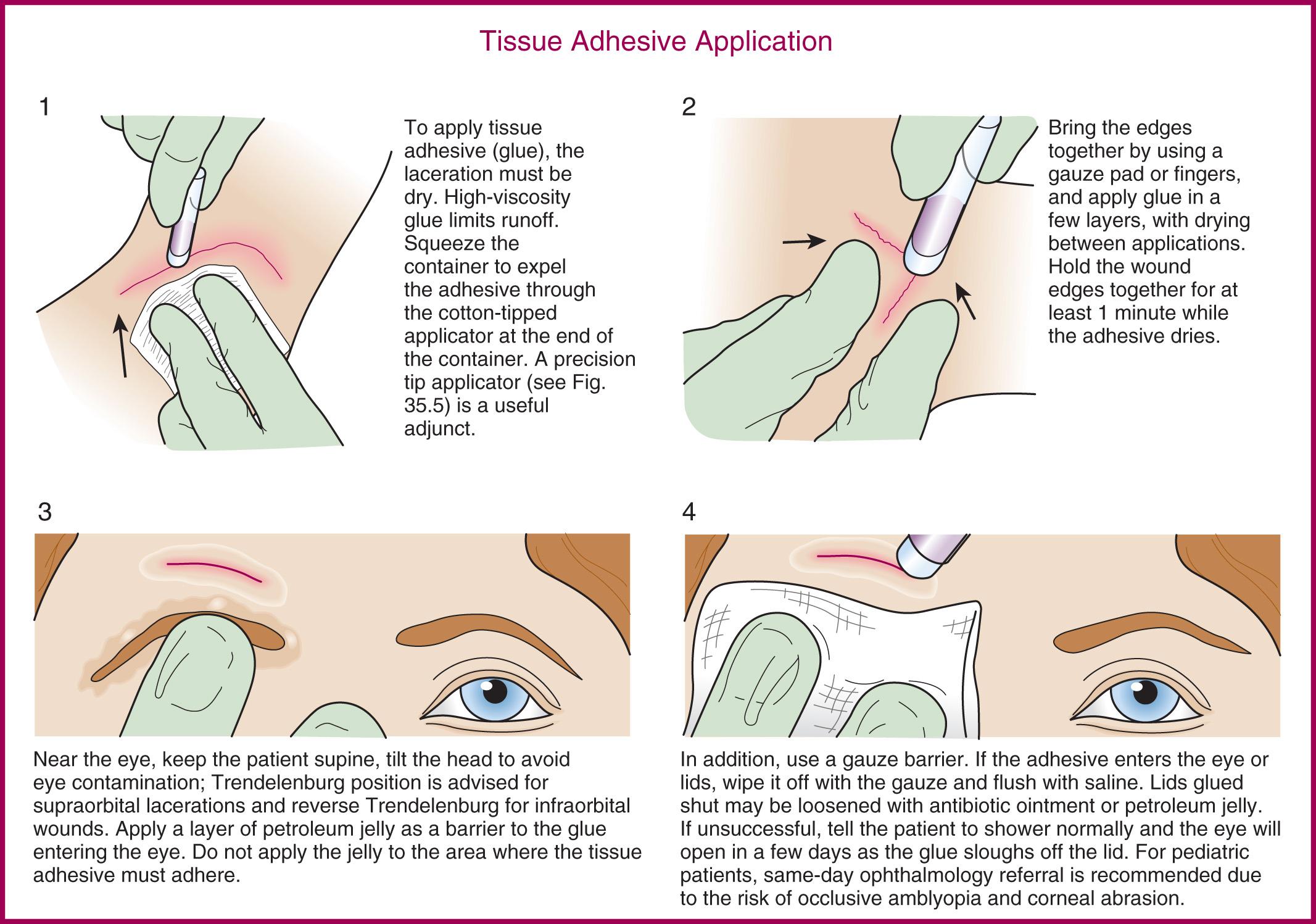 Figure 35.7, Application of tissue adhesive. Note: glue that touches a latex glove, gauze, or a plastic instrument (but not vinyl gloves or metal instruments) will cause them to stick to the patient.