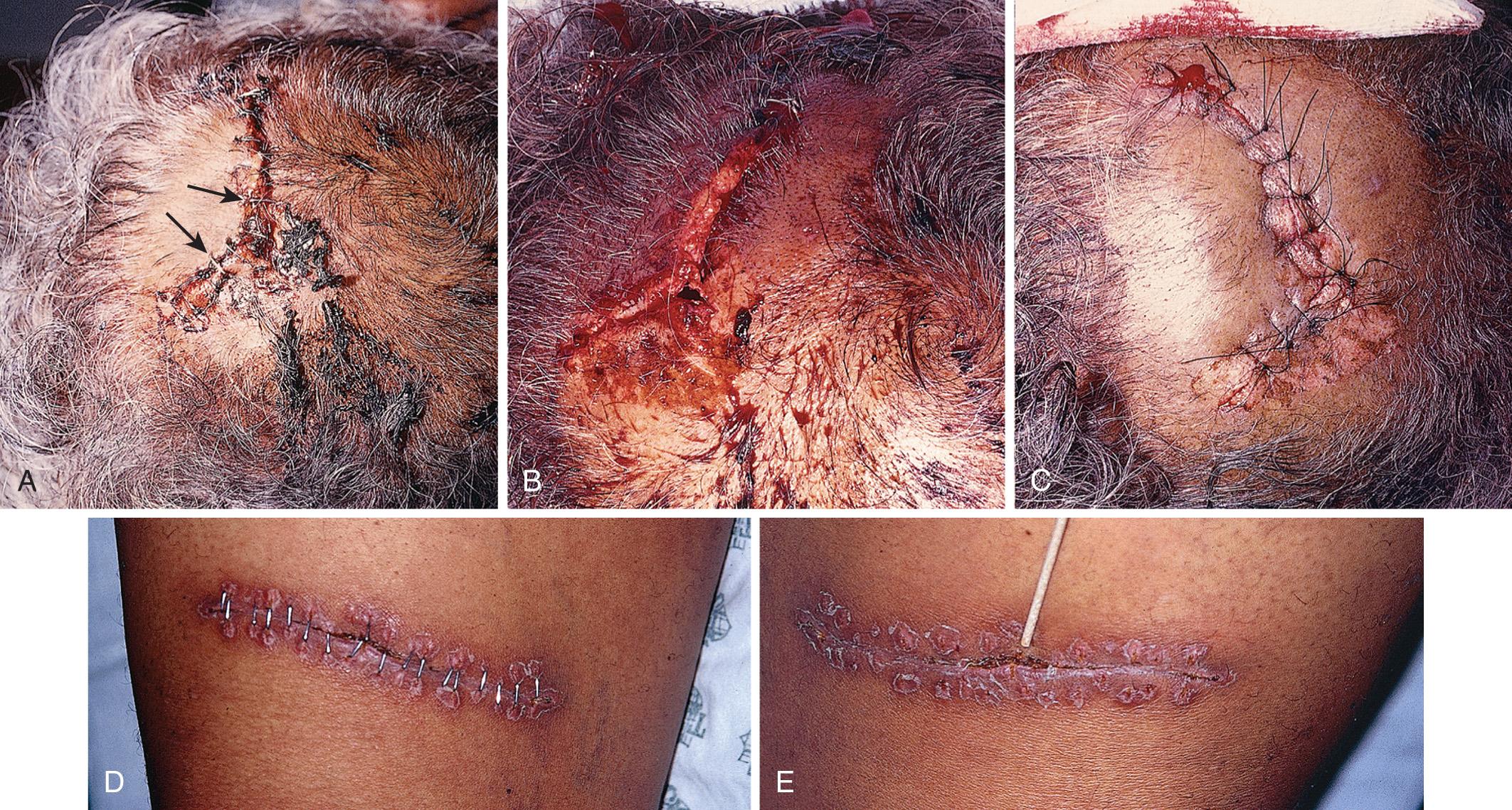 Figure 35.10, A, A very poor result occurred when staples (some marked with arrows ) were used to close this deep scalp laceration. The edges of the wound were not everted, staples were not in the midline, sections of the skin overlapped significantly, poor hemostasis was obtained, and the galea could not be closed by the superficial staples. The patient did not wash his hair as instructed. B, Three days later during inspection of the wound, the staples were removed and C, the laceration was closed with 3-0 interrupted nylon sutures. The clinician should attempt to obtain a cosmetic closure on all scalp lacerations because as patients lose their hair, a previously hidden, unsightly scar emerges. In general, staples should not be used to close full-thickness scalp lacerations, especially wounds that are actively bleeding. D, Sloppy stapling on an extremity with inversion rather than eversion of the edges of the wound. Some staples are totally misaligned and barely include the opposite skin edge. E, The staples were left in too long, which caused a poor cosmetic result.