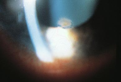 Fig. 27.3, Slit lamp photograph of the corneal ulcer depicted in Figure 27.2 .