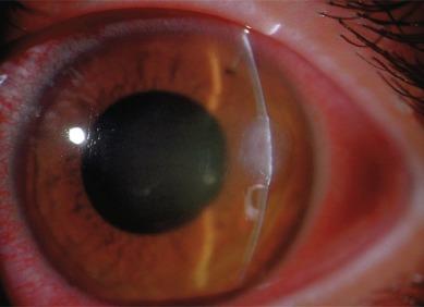 Fig. 27.5, Moderately advanced case of contact lens–induced microbial keratitis, displaying a swirling, circular, milky-white infiltrate. The intense limbal and bulbar redness indicates the active nature of the condition.