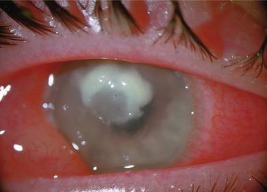 Fig. 27.6, Creamy, pussy ulcer in the advanced stage of a contact lens–induced microbial keratitis.