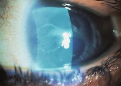 Fig. 27.7, Breakdown of the epithelium in the classic pattern of radial keratoneuritis in a patient with Acanthamoeba keratitis.