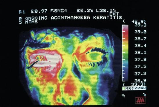 Fig. 27.8, Ocular thermogram of a patient with Acanthamoeba keratitis of the right eye, showing the increased temperature of the affected eye.