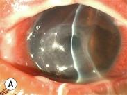 Fig. 27.9, Four cases of contact lens–associated Fusarium keratitis seen in Singapore. (A) Central stromal ring infiltrate, grade 2.3. (B) Central round infiltrate with indistinct feathery edges and satellite lesions, grade 2.8. (C) Central vertically oval ulcer with an inset ring infiltrate, indistinct feathery edges and small satellite lesions, grade 3.2. (D) Pan-corneal opacification with dense ring infiltrate and large hypopyon, grade 4.0.