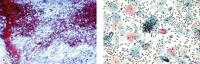 Figure 7-1, Heavy, acute inflammatory exudate. (A) Cervicovaginal smear (Papanicolaou, ×LP). (B) Note the reduced background inflammation in the LBGS (Papanicolaou, ×LP).